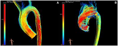 Hemodynamic Profiles Before and After Surgery in Bicuspid Aortic Valve Disease—A Systematic Review of the Literature